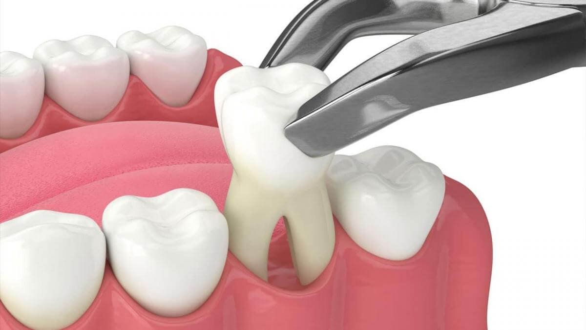How Long After Tooth Extraction Can I Use a Straw?