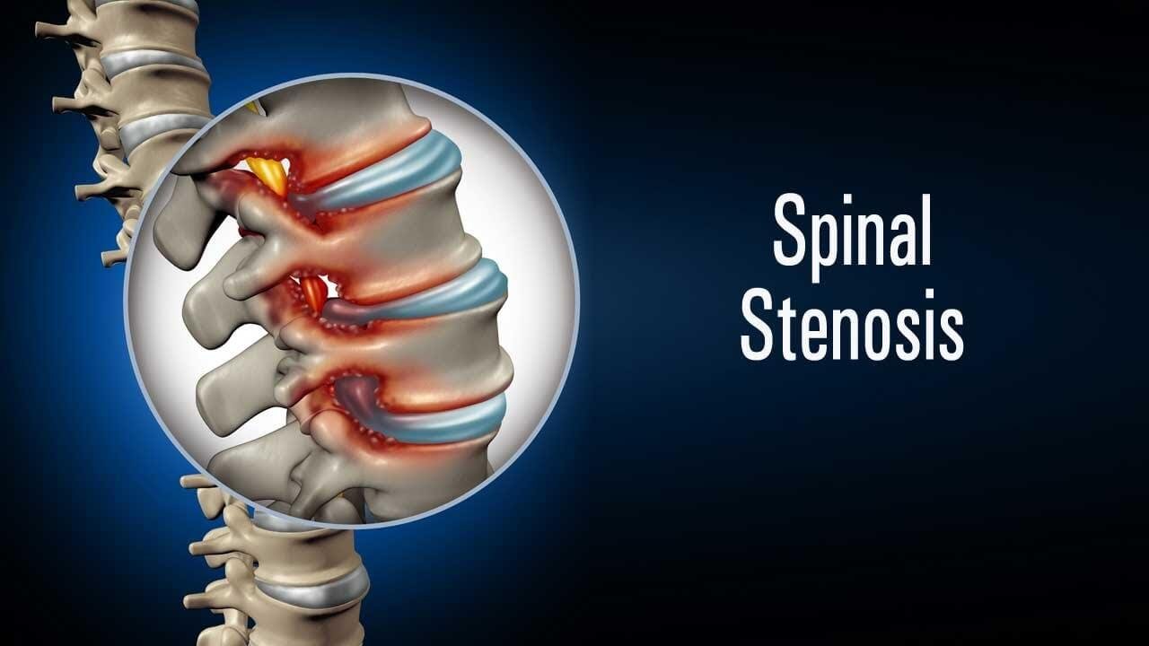What is the Newest Treatment For Spinal Stenosis?